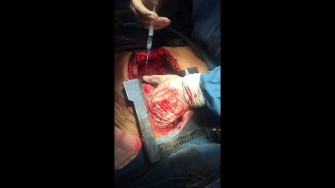 Cardiocirugía Sonora 1