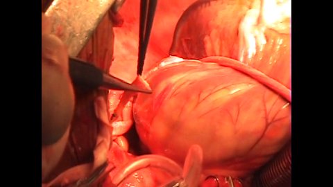 Cuba Coronary Bypass