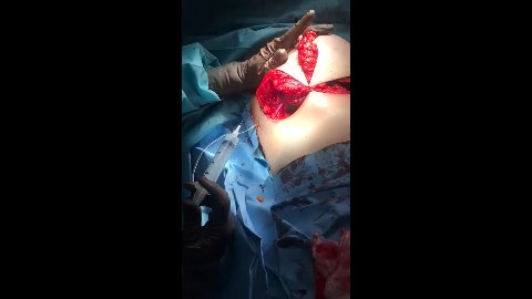 Reducción Mamaria Con Implantes 2