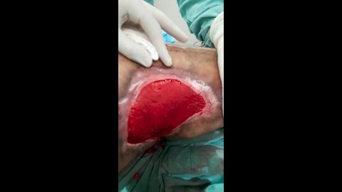 Seraseal Aplicación Úlcera