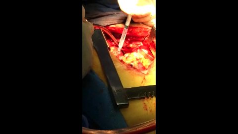 Seraseal Cirugía Cardíaca