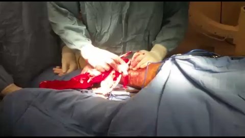 Seraseal Cirugía De Trauma