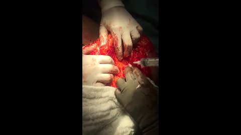 Seraseal Detiene Sangrado Arterial