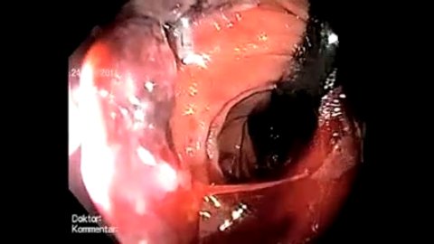 Seraseal For GI Bleeding