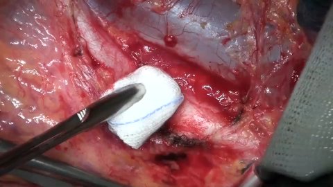 Seraseal Vas Vasorum Preview 3