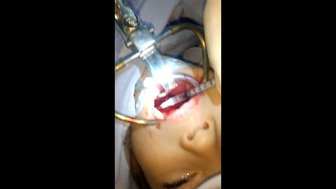 Aplicación Lecho Amigdalino