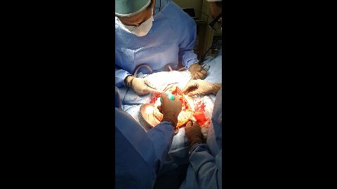 Desarticulación De Cadera