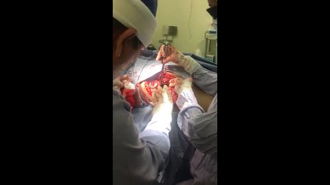 Fractura De Cadera Parte 2 - Colima