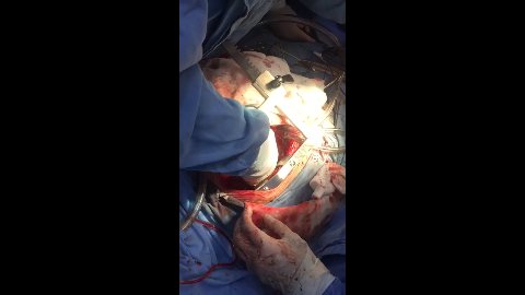 Hospital Regional IMSS - Cambio De Válvula Mitral