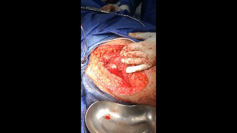 Osteotomía De Cadera 2