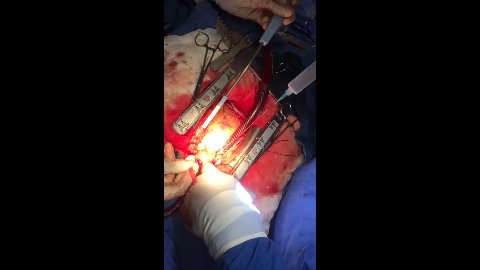 Revascularización Cardíaca - Paciente 78 Años