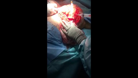 Reducción Mamaria Con Implantes - Mérida