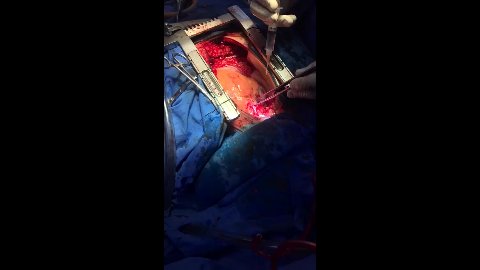 Seraseal Cirugía Cardíaca - BC