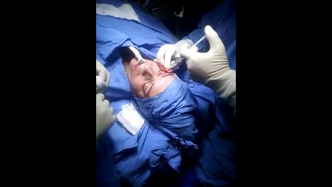 Seraseal Cirugía De Párpados