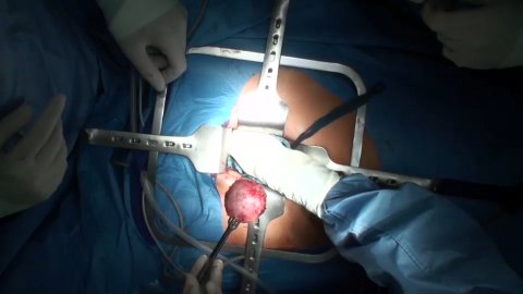 Seraseal Myom (German) 2