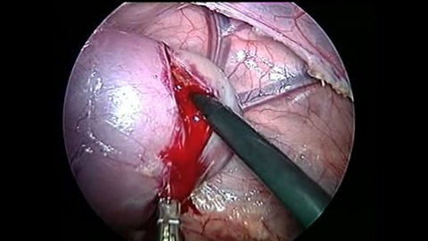WLI Nephrectomy (Clip)
