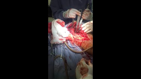 Fractura De Cadera - Cirugía De Revisión Parte 1