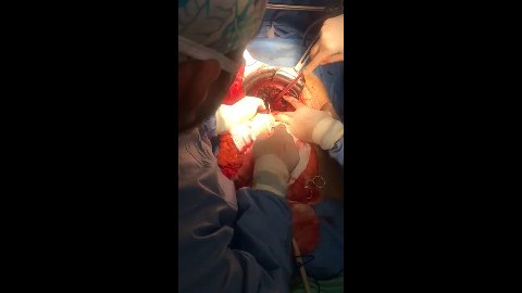 Hepatectomía Con Metástasis - Dr. Gámez