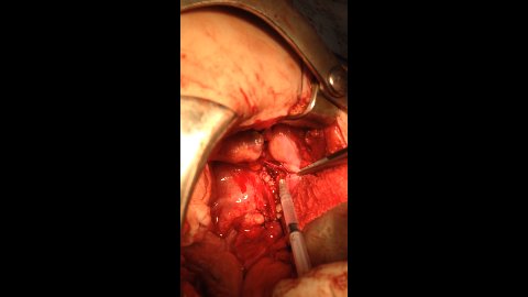 Histerectomía - Dr. Ricardo ISSSTE